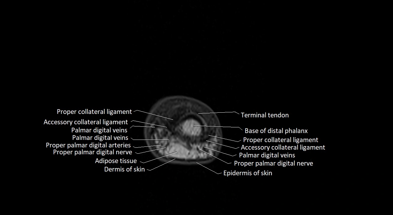 Finger anatomy axial cross sectional 3T image image 5.webp